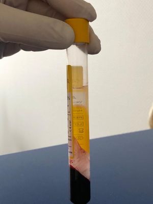 Eine Spritze mit Platelet Rich Plasma