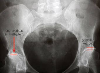 Röntgenbild von Arthrose