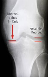Röntgenbild vom Knie