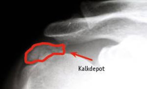 Röntgenbild eines Kalkdepots